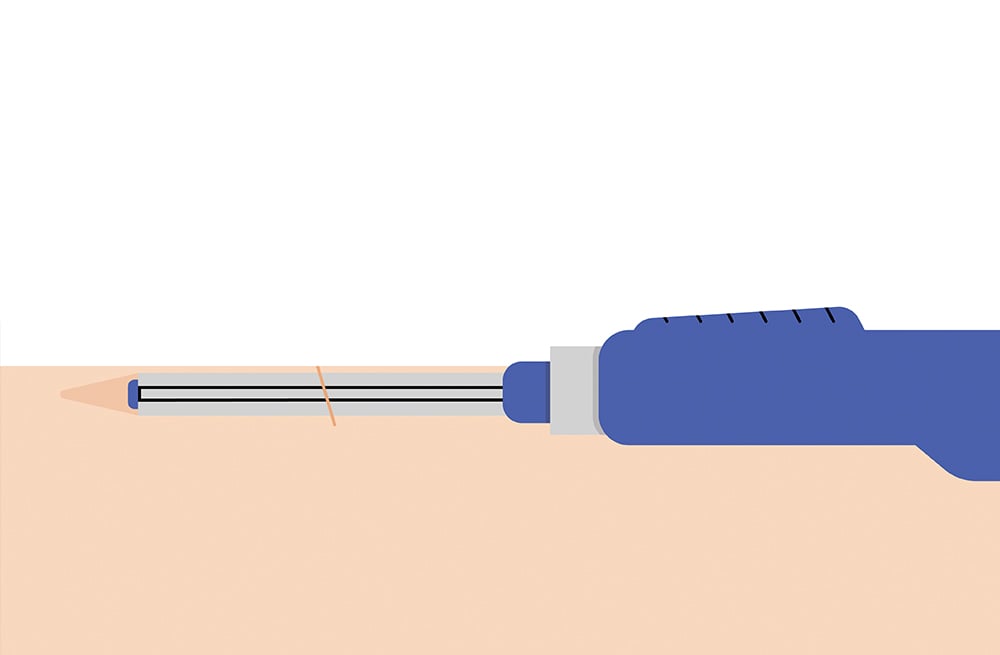 Deuxième étape de la procédure d’insertion du CGM Eversense implantable.