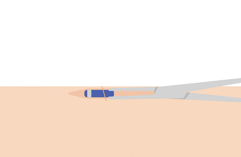 Deuxième étape des procédures d’insertion et de retrait pour un système de surveillance du glucose portable.